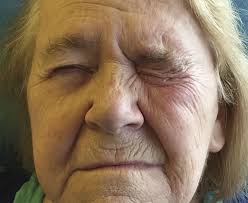 Precentral gyrus infarct presenting as isolated contralateral  peripheral-type facial palsy