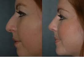 We did not find results for: How Much Does A Nose Job Cost Winter Park Rhinoplasty Winter Park Plastic Surgery Laser Center