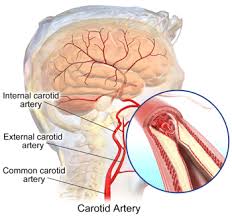 Image result for carotid artery
