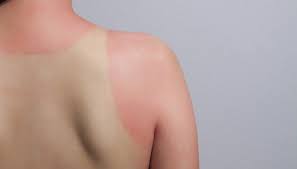 How To Reverse Sun Damage 4 Experts Share Their Top Tips Beauty Routines Skin Healing Laser Skin