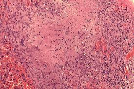 Lee boon cheok is an urologist recognised by the national specialist register and the ministry of health. Spontaneous Bladder Perforation A Rare Complication Of Tuberculosis International Journal Of Infectious Diseases