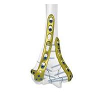 Distal Humeral Locking Plate Ⅱ,Medical Device Manufacturers ...