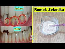 Karang Plak Gigi Rontok Dan Ambrol Seketika Hanya 1 Malam Youtube Gigi Karang Pola Jahitan