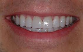 Porcelain Veneers Color Chart Poisk V Google Cosmetic Dentures Dentist Near Me Tooth Chart