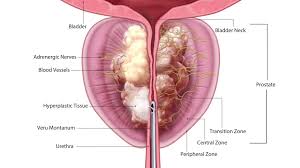 Rezum Procedure Enlarged Prostate Prostate Benign Prostatic Hyperplasia