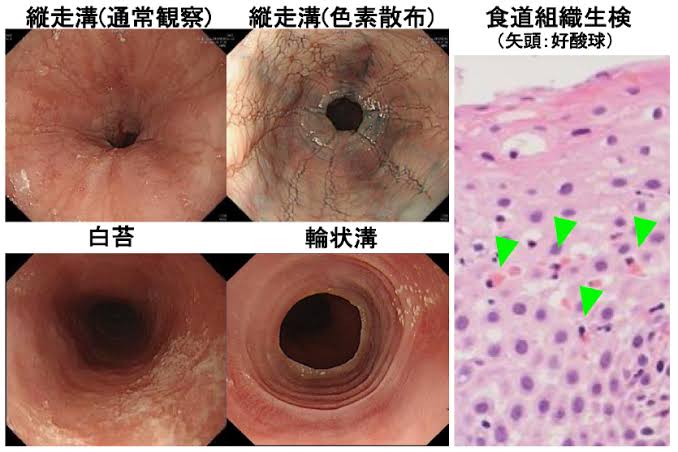 好酸球性消化管疾患（EGID）～アレルギーセンターの取り組み～ | KOMPAS – 慶應義塾大学病院 医療・健康情報サイト