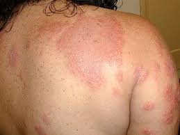 skin cancer may initially appear as a nodule rash or irregular patch on the surface of the skin. What S Causing This Cancer Patient S Painful Rash Amsa