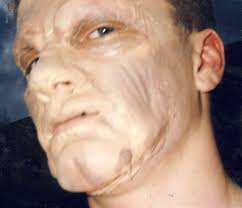 C O M M O N PROSTHETIC APPLICATION PROBLEMS