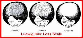 Stages Of Male Female Pattern Baldness Thinscalp Com