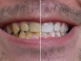 Vitamin c heavy fruits are great for removing plaque at home. 10 Ways To Clean Yellow Teeth Naturally