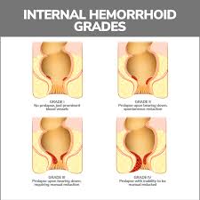 Hemorrhoids: Everything to Know | Gastroenterology Orlando