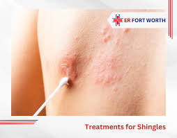 Image result for shingles