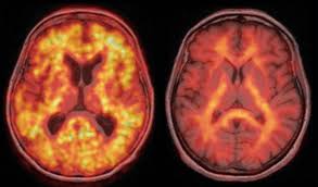 Start with the 4 a's. Morbus Alzheimer Uber Seine Demenz Im Bilde Sein