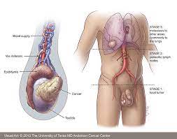 Stage iii testicular cancer has three subcategories: Testicular Cancer Has 3 Main Faraja Cancer Support Trust Facebook