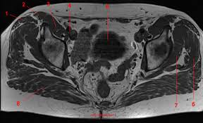 Pelvis bony pelvis, external measurements pelvic planes and their measurements pelvic floor muscles in relation to childbirth uterine tubes and ovaries female endopelvic fascias, ligaments supporting uterus, uterine prolapse nerve blocks of the perineum (pudendal and ilioinguinal). Mri Of The Hip Detailed Anatomy W Radiology