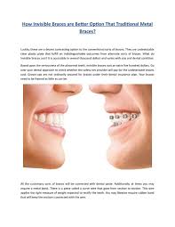 We did not find results for: How Invisible Braces Are Better Option That Traditional Metal Braces By Huntingdale Dental Care Issuu