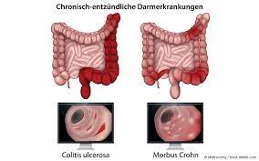 Fettes Essen Und Antibiotika Fordern Ced Gelbe Liste