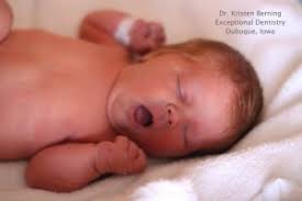 Dubuque Laser Dentist: Lip and Tongue Tie revision