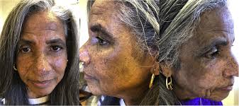 Image result for Diffuse Hyperpigmentation