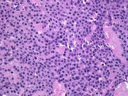 Image result for Glomus tumor