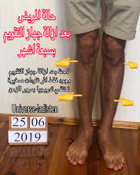 سر نجاحنا في علاج تقوس الساقين وتشوهات الأطراف 1 جهاز التقويم الحصري المستخدم في العلاج في مركزنا veklich fixator الذي هو من تطوير الدكتور فيتالي فيكلج الطبيب المعالج