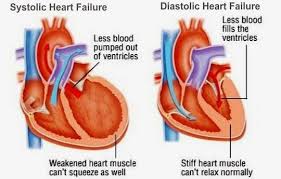 Image Result For Systolic Vs Diastolic Heart Failure Diastolic Heart Failure Heart Failure Systolic Heart Failure