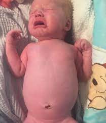 Is Her Belly Bigger Than It S Supposed To Be March 2017 Babycenter Canada