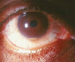 Image result for Uveitis