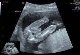 Check out romper's new video series, bearing the motherload, where disagreeing parents from different sides of an issue sit down with a mediator and talk about how to support (and. How Early Can I Find Out My Baby S Gender The Ultrasound Suitethe Ultrasound Suite