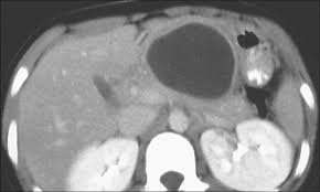 Pseudocyst In 10 Year Old Girl Ct Scan Shows Posttraumatic Download Scientific Diagram