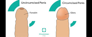 Image result for paraphimosis