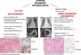 Myocarditis is a condition that is characterized by inflammation of the heart muscle (myocardium).some affected people have no noticeable symptoms of the condition. Management Of Acute Myocarditis And Chronic Inflammatory Cardiomyopathy Circulation Heart Failure