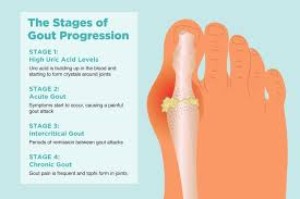 The 4 Stages Of Gout And Preventing Disease Progression