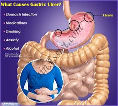 Pin On Abdominal Pain Or Stomach Pain