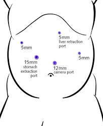 Gastric Sleeve Illustrations Gastric Sleeve Steps Gastric