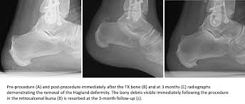Haglund deformity, also known as a pump bump , bauer bump, or mulholland deformity, is defined as bony enlargement formed at the posterosuperior aspect of the calcaneum. Walter Sussman On Twitter Tx Bone For Haglund Deformity Tenex Tendoninjury Tendinitis Achillestendon