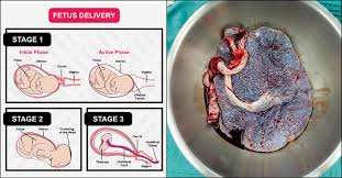 Delivery suite manager & guideline midwife. Retained Placenta Causes Symptoms And Treatment