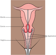 They cannot tell for certain if you have cervical cancer. Radiotherapy For Cervical Cancer Macmillan Cancer Support