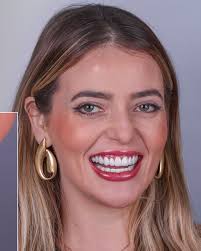 Transformação completa do sorriso com Resina Composta! E saiu um post um  pouco diferente do normal 😬 O que acharam? . . . Dra. Mariana Zeitune  CRO/SP: 115473 📍Eme Clinic/IMZ: Rua Fritz