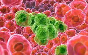 Prostate cancer is one of the leading cancers in men. Prostate Cancer Survivors Now Live Longer Than The Average Man As Long As The Disease Is Caught Early