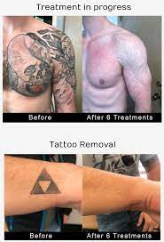 Average tattoo prices range from $30 to $100 for sizes under 2x2, between $100 and $200 for a 3x3, and around $250 or more for a 4x4 tattoo. Tattoo Removal Los Angeles Laser Tattoo Removers
