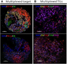 Precision is paramount, collaboration is crucial. Expression And Clinical Significance Of Pd L1 B7 H3 B7 H4 And Tils In Human Small Cell Lung Cancer Sclc Springerlink