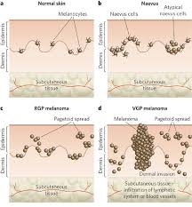 However, a local recurrence of a melanoma has a more finite range of appearances. Melanoma Biology And New Targeted Therapy Nature