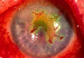 Initially, topical steroids with antiviral cover, both used four a. Current Treatment Of Herpes Simplex Virus Keratitis