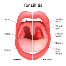Image result for Tonsillitis