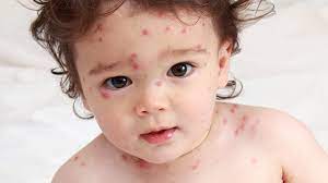 Penyakit campak (rubeola, campak 9 hari, measles) adalah suatu infeksi virus yang sangat menular, yang ditandai dengan demam, batuk, konjungtivitis (peradangan selaput ikat mata/konjungtiva) dan ruam kulit. Klinik Putra Pokok Sena 6 Petua Hilangkan Demam Campak