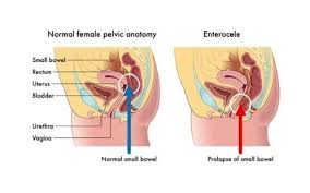 Image result for Fecal Incontinence