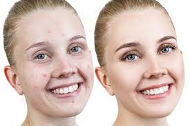 Earn 5% rewards on every order. How To Get Rid Of Acne Overnight 12 Remedies That Work