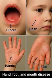 Kes HFMD di negeri Johor membimbangkan dan melebihi paras amaran.  Peringatan buat semua berkaitan kes mendadak HFMD. Dah banyak kes tadika  kena kuarantin dekat Johor. Anak-anak kecil merana, ibu bapa panik, satu