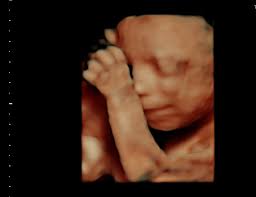 A powerful suction tube with a sharp cutting edge is inserted into the womb through the dilated cervix. How Will Your Baby Look In A 3d Ultrasound